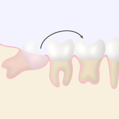 歯牙移植と歯牙再植